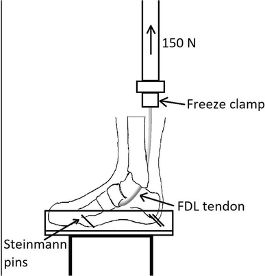 Flexor Digitorum Longus Tendon Transfer To The Navicular Tendon To