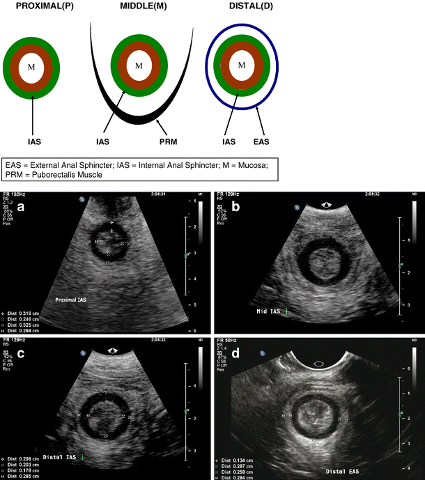 Translabial ultrasound assessment of the anal sphincter complex: normal ...