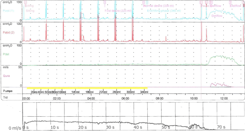 post void residual urine in female post void residual urine in female