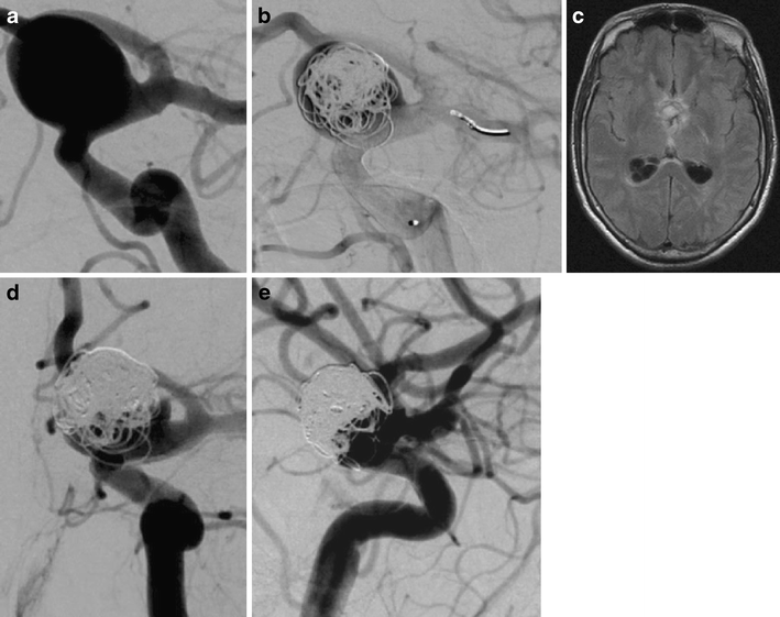 Pipeline embolization device (PED) for neurovascular reconstruction