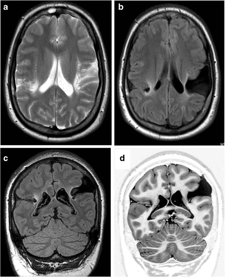 Schizencephaly revisited | SpringerLink
