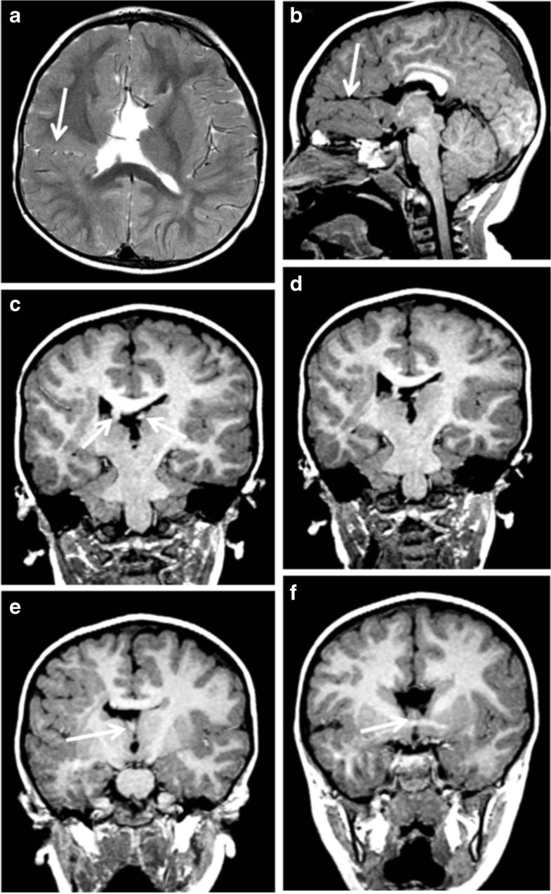 Schizencephaly revisited | SpringerLink