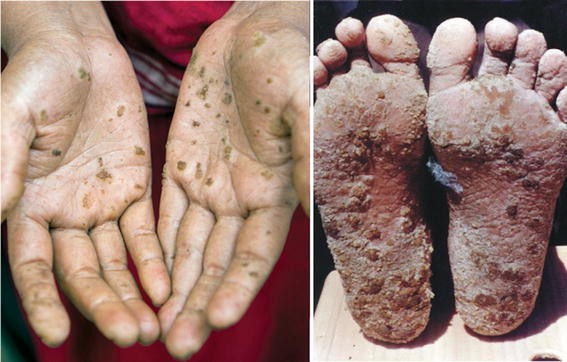 The Arsenic Contamination Of Drinking And Groundwaters In - 