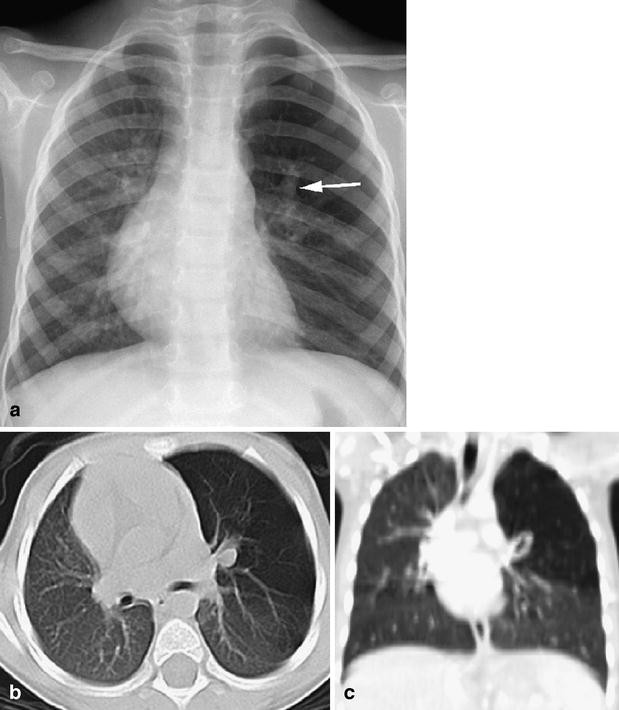 Congenital bronchopulmonary foregut malformations: concepts and ...