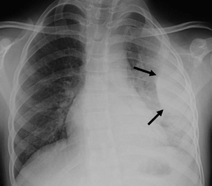 Imaging of parapneumonic pleural effusions and empyema in children ...