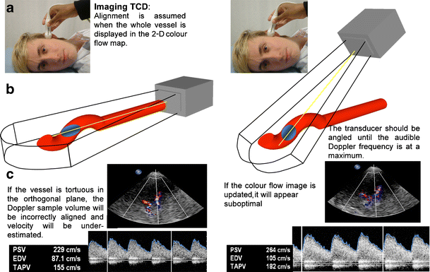 transcranial doppler technique