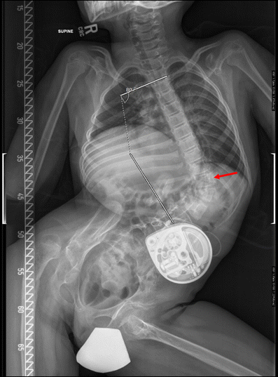 compression fracture t12 vertebra icd 10 compression fracture t12 vertebra icd 10