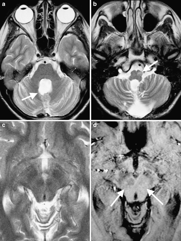 Red nucleus degeneration in hypertrophic olivary degeneration after