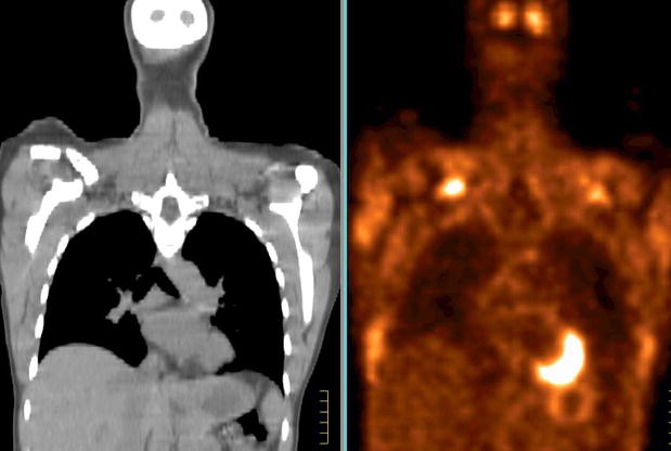 PET/CT and MR imaging in myeloma | SpringerLink