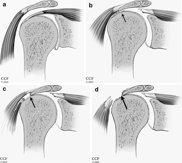 Deltoid muscle and tendon tears in patients with chronic rotator cuff ...