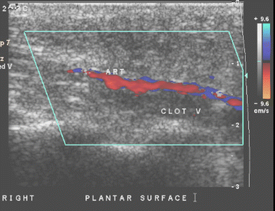 plantar vein thrombosis fig cause pain foot rare