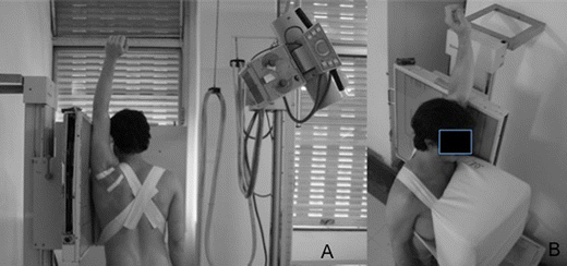Calculating anterior glenoid bone loss using the Bernageau profile view