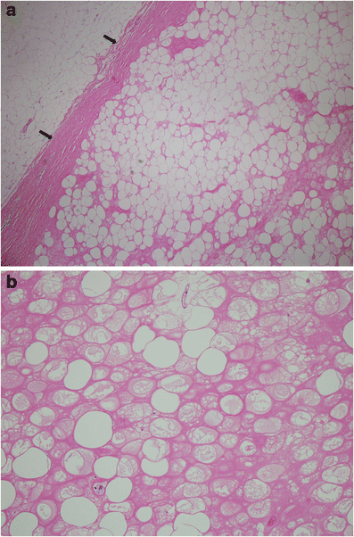 Encapsulated fat necrosis mimicking subcutaneous liposarcoma ...