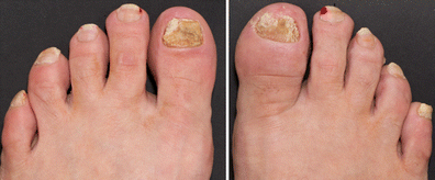 TEST YOURSELF: Answer psoriatic onycho-pachydermo ...
Onychodystrophy