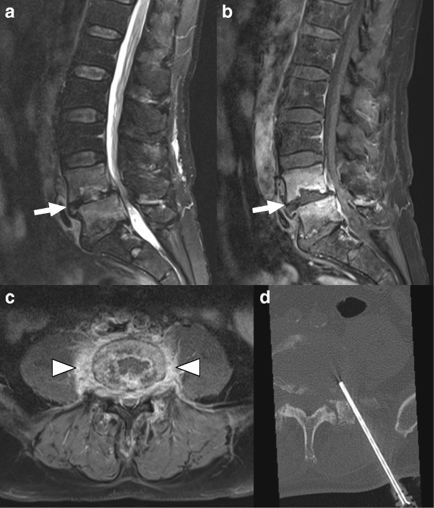 CT-guided biopsy in suspected spondylodiscitis: microbiological yield ...