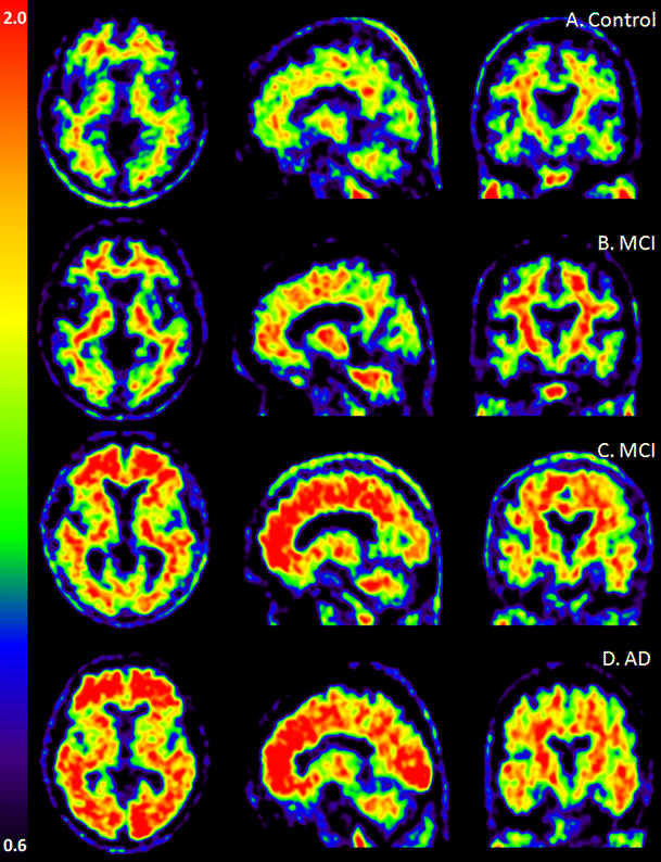 Using PET with 18F-AV-45 (florbetapir) to quantify brain amyloid load ...