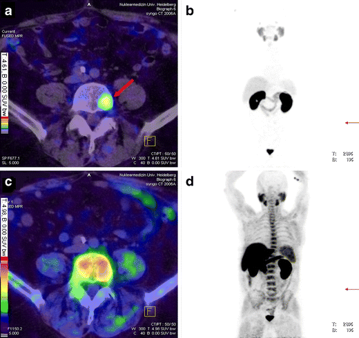 Comparison of PET imaging with a 68Ga-labelled PSMA ligand and 18F ...