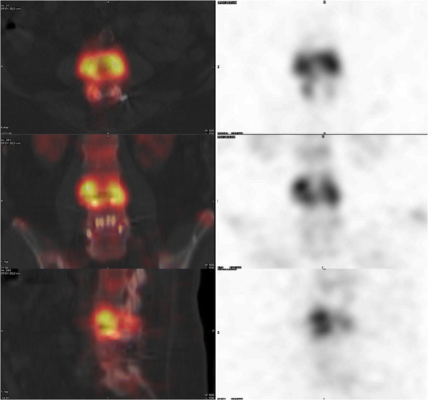 Accuracy of bone SPECT/CT for identifying hardware loosening in