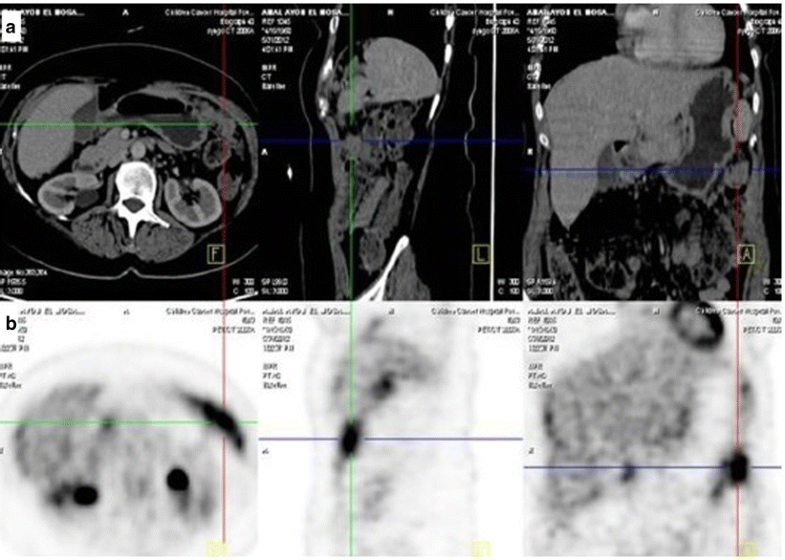 An update on the role of PET/CT and PET/MRI in ovarian cancer