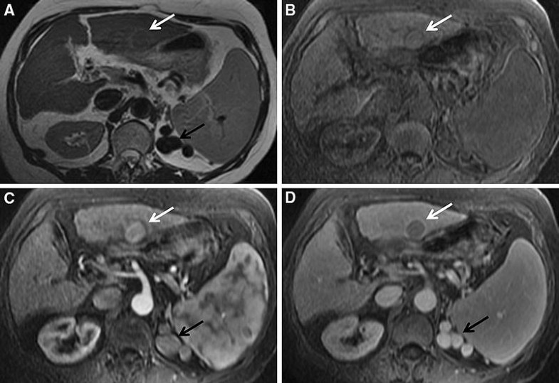 Autoimmune hepatitis CT and MR imaging features with histopathological