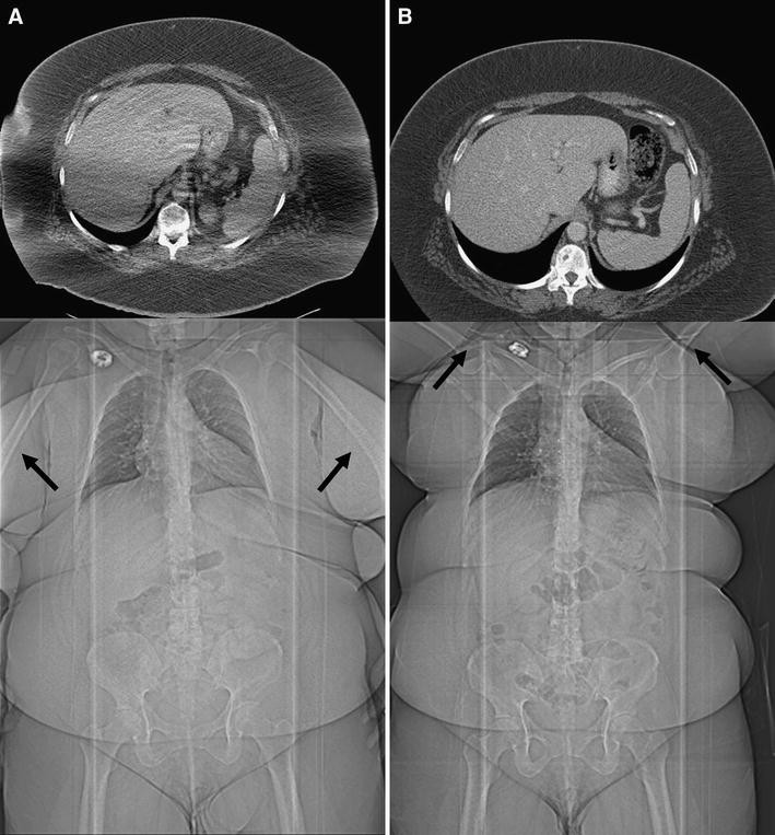 Imaging obese patients problems and solutions SpringerLink