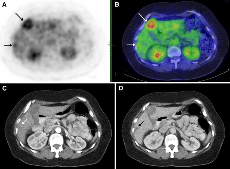 FDG PET/CT in the liver: lesions mimicking malignancies | SpringerLink