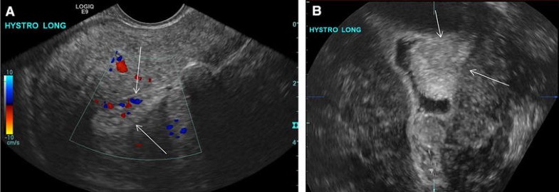 Through thick and thin: a pictorial review of the endometrium ...