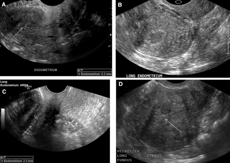 Through thick and thin a pictorial review of the endometrium