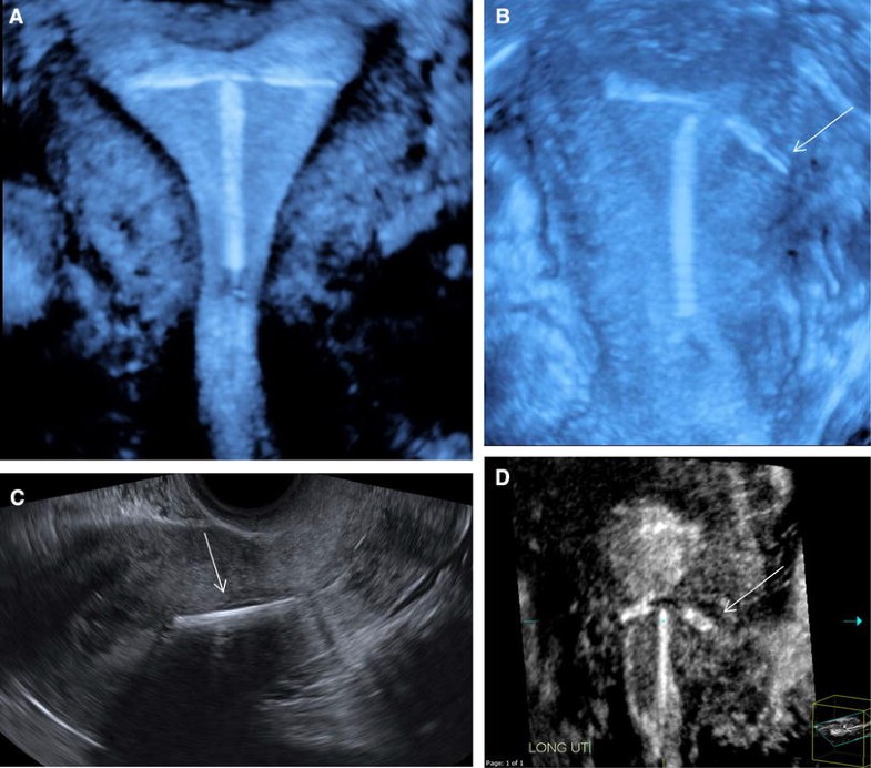 Through thick and thin a pictorial review of the endometrium