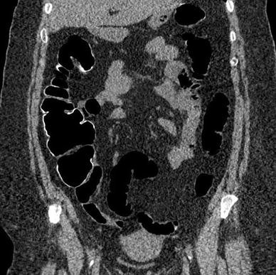 Ct Colonography Interpretation How To Maximize Polyp - 