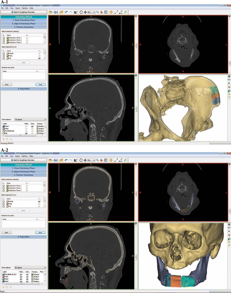 Computer-assisted Mandibular Reconstruction with Vascularized Iliac