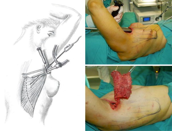 Endoscopic Reconstruction of Partial Mastectomy Defects Using