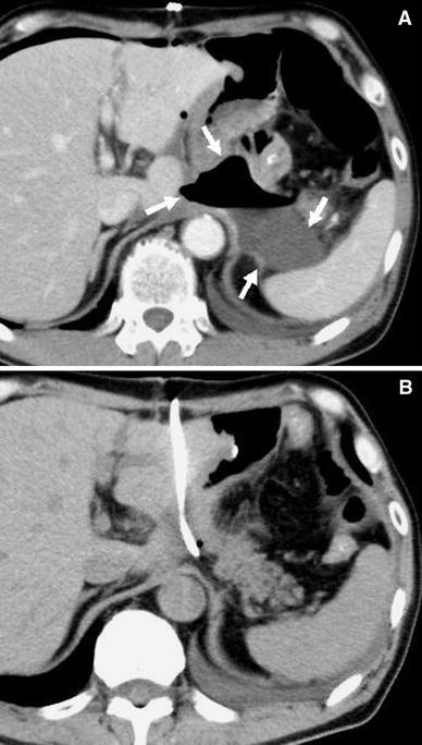 Percutaneous Transhepatic Drainage of Inaccessible Abdominal Abscesses ...