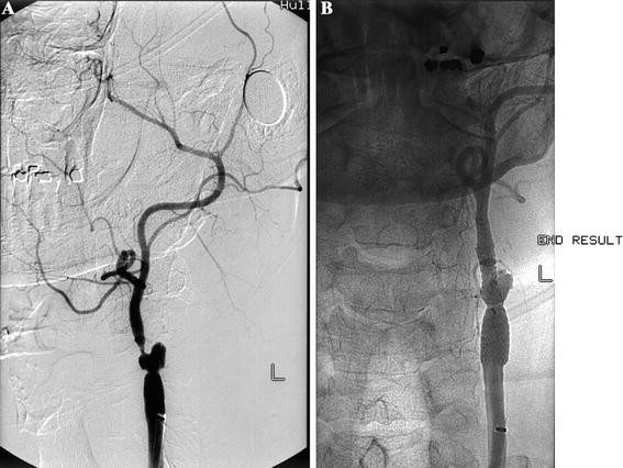 Carotid Stump Syndrome Pathophysiology And Endovascular Treatment