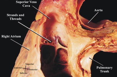 Chiari’s network: review of the literature | SpringerLink