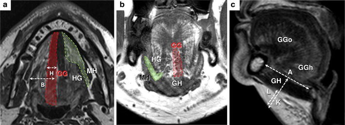 Specific branches of hypoglossal nerve to genioglossus muscle as a
