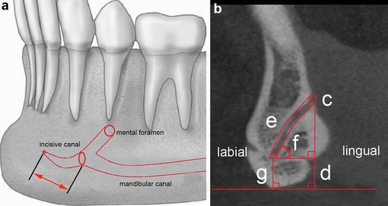 Anatomical landmarks of mandibular interforaminal region related to