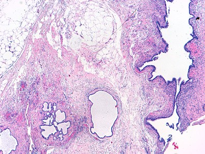 Endometrioseassoziierte Tumorerkrankungen des Ovars ...