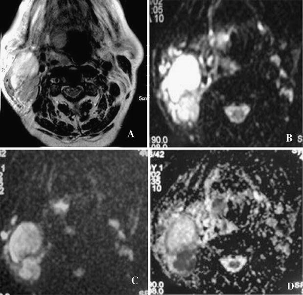 Role Of Diffusion Weighted Mr Imaging In Cervical Lymphadenopathy