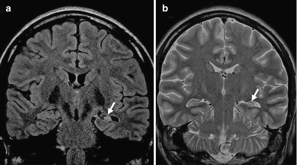 Structural Magnetic Resonance Imaging In Epilepsy Springerlink - 