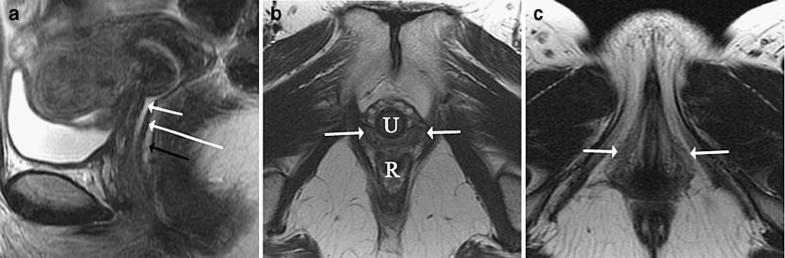 Magnetic resonance imaging of vaginal and vulval pathology | SpringerLink