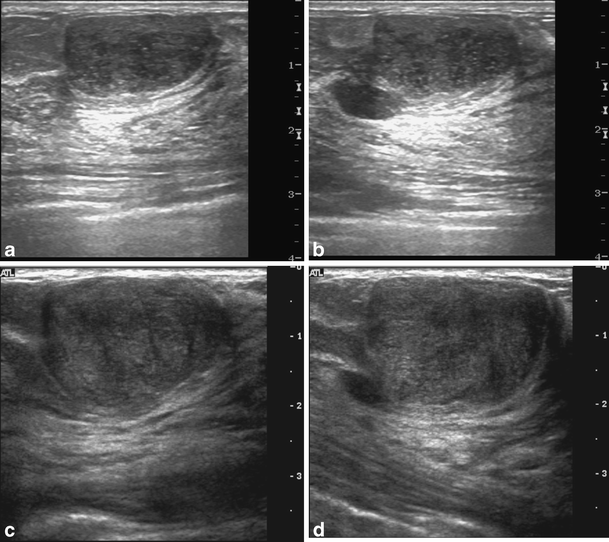 Interval growth of probably benign breast lesions on followup