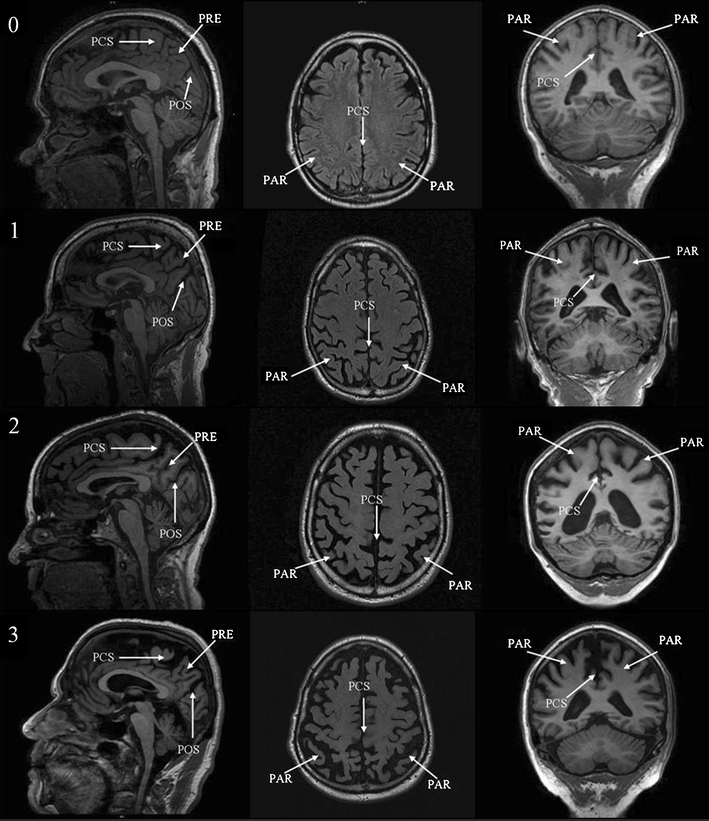 Visual assessment of posterior atrophy development of a MRI rating scale SpringerLink