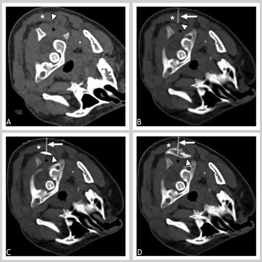 A simplified CTguided approach for greater occipital nerve