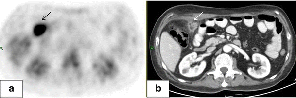 Fat necrosis after abdominal surgery: A pitfall in interpretation of ...