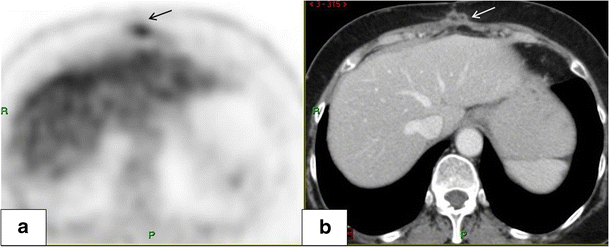 Fat necrosis after abdominal surgery: A pitfall in interpretation of ...