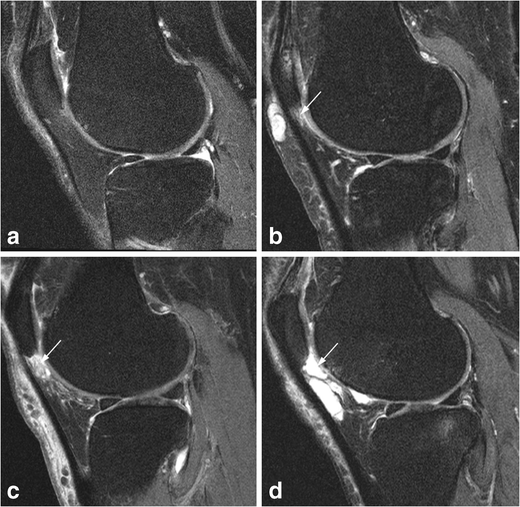 Superolateral Hoffa’s fat pad (SHFP) oedema and patellar cartilage ...