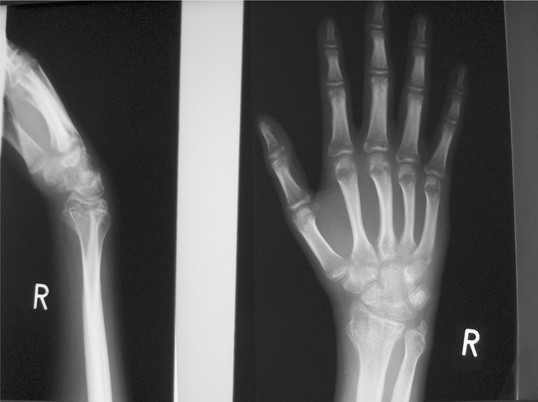 Morbus Sudeck an der Hand SpringerLink