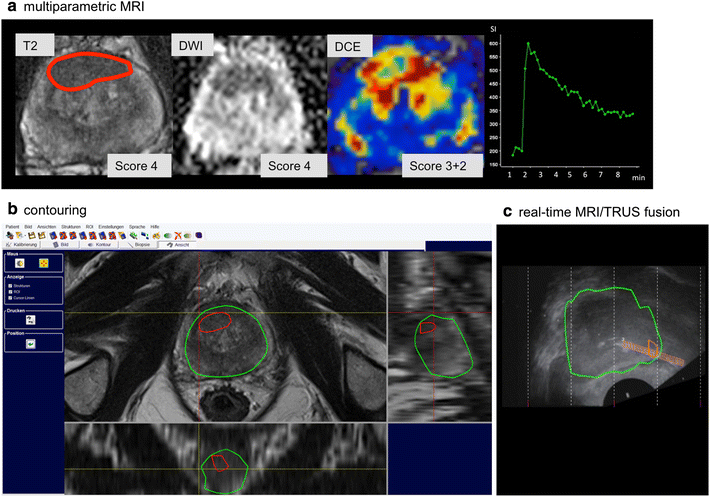 Targeted Mri Trus Fusion Guided Biopsy In Men With Previous Prostate