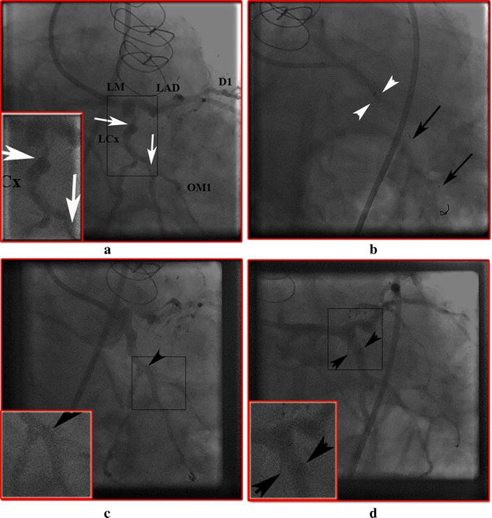 guideliner catheter guideliner catheter